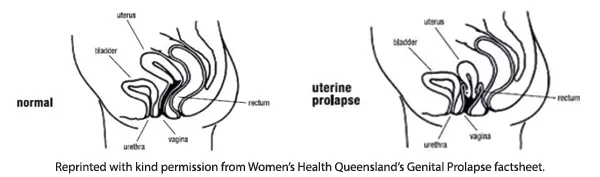 Prolapse diagram